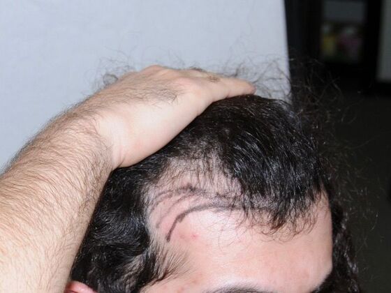 FUT Hair Restoration: Case 28 - Before