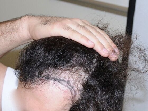 FUT Hair Restoration: Case 28 - Before