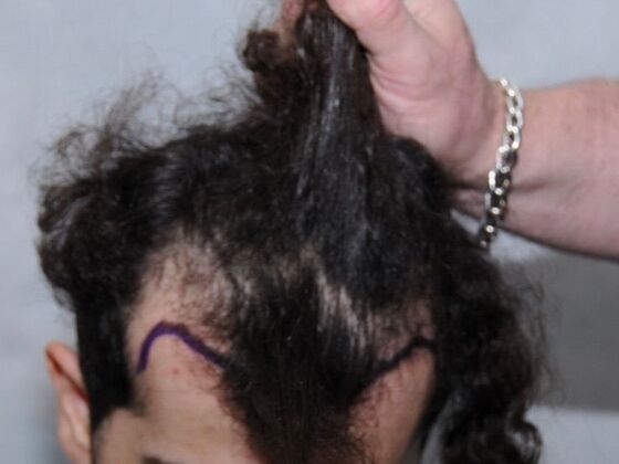 FUT Hair Restoration: Case 28 - Before