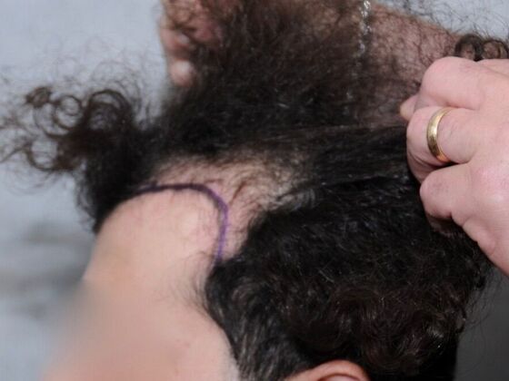 FUT Hair Restoration: Case 28 - Before