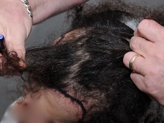 FUT Hair Restoration: Case 28 - Before