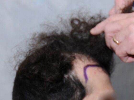 FUT Hair Restoration: Case 28 - Before