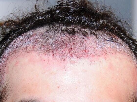 FUT Hair Restoration: Case 28 - Before