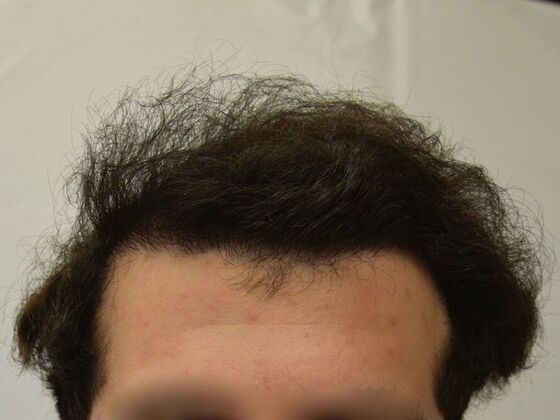 FUT Hair Restoration: Case 28 - After