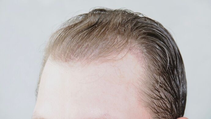 FUT Hair Restoration: Case 29 - Before