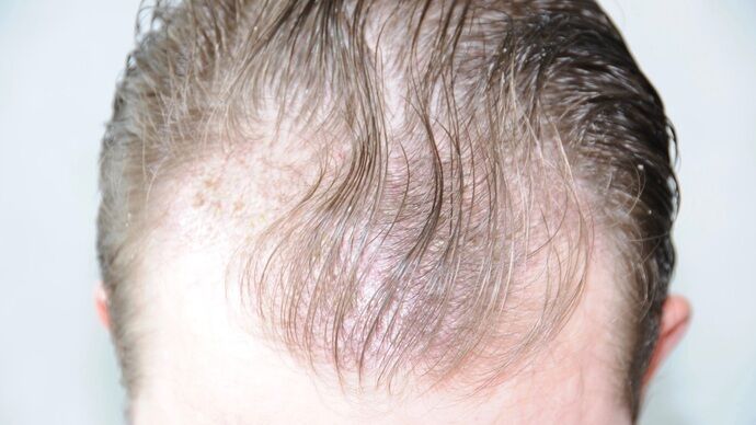 FUT Hair Restoration: Case 29 - Before