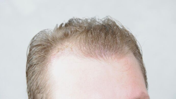 FUT Hair Restoration: Case 29 - Before