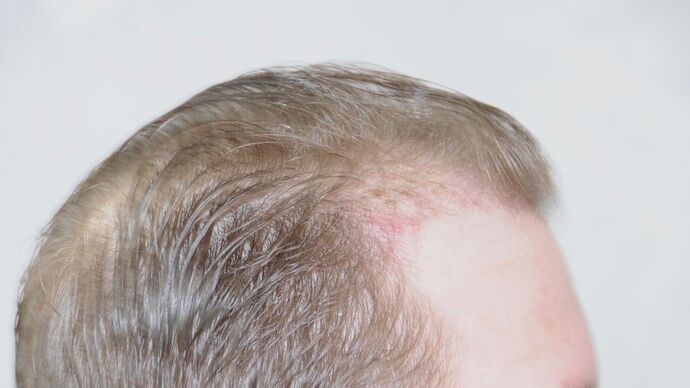 FUT Hair Restoration: Case 29 - Before