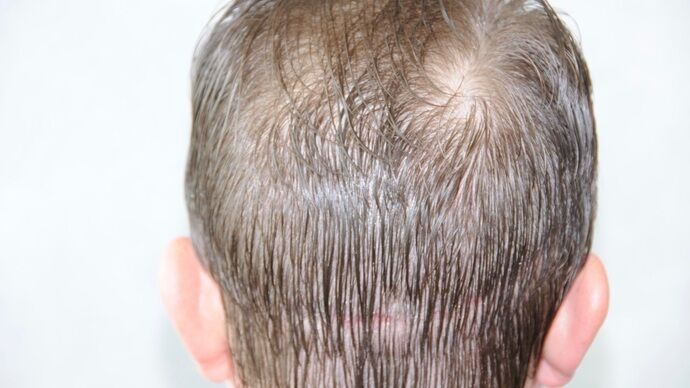 FUT Hair Restoration: Case 29 - Before