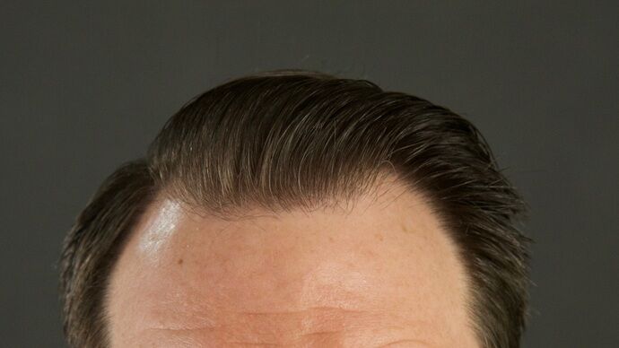 FUT Hair Restoration: Case 29 - After