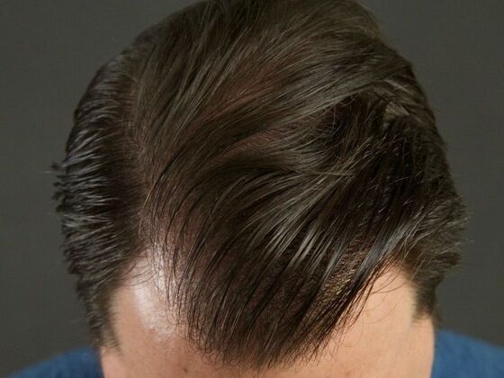 FUT Hair Restoration Case 29 - After