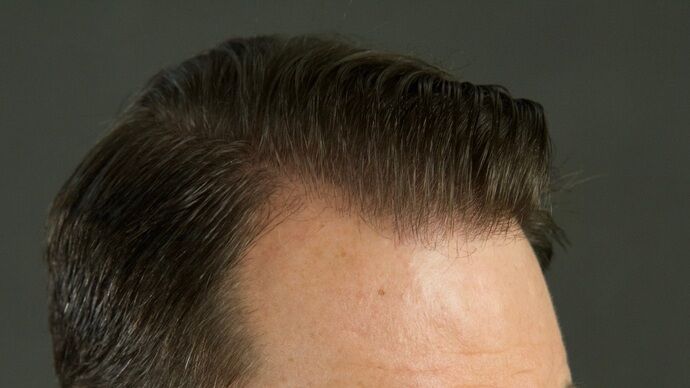 FUT Hair Restoration: Case 29 - After