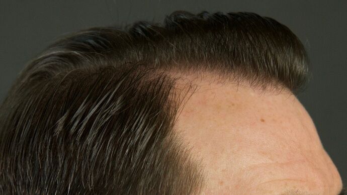 FUT Hair Restoration: Case 29 - After