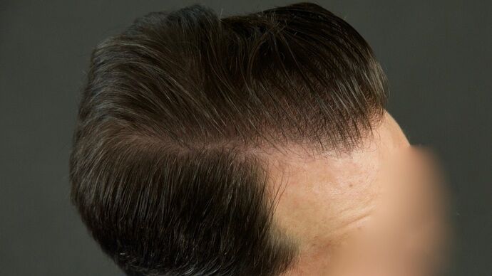 FUT Hair Restoration: Case 29 - After