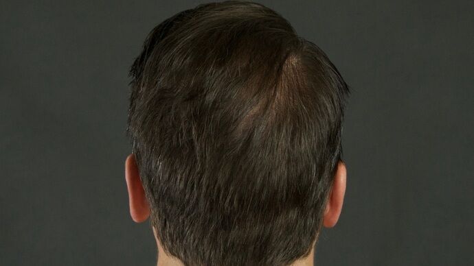 FUT Hair Restoration: Case 29 - After