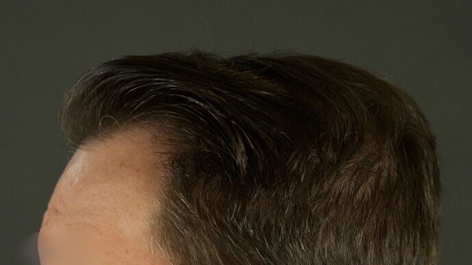 FUT Hair Restoration: Case 29 - After