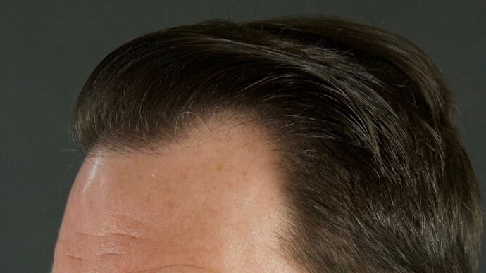 FUT Hair Restoration: Case 29 - After