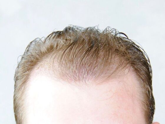 FUT Hair Restoration Case 29 - Before