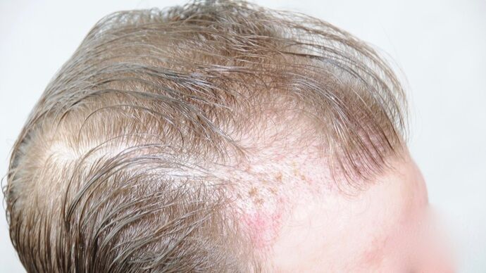 FUT Hair Restoration: Case 29 - Before