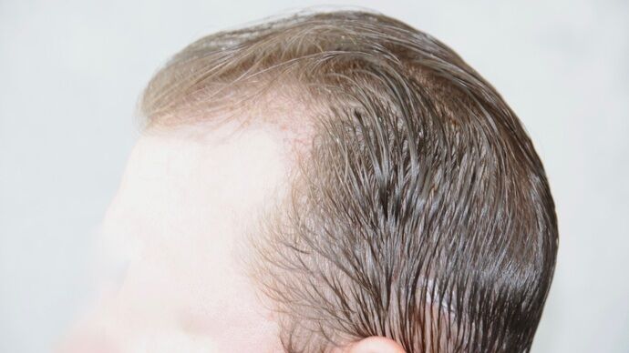 FUT Hair Restoration: Case 29 - Before