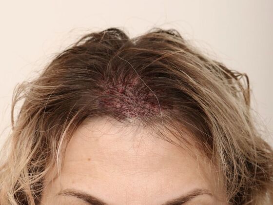 Hair Transplant - Female: Frontal FUT (6) - Post-op female hair transplant