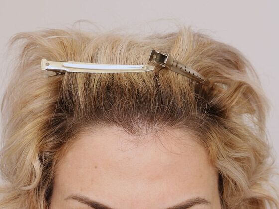 Hair Transplant - Female: Frontal FUT (6) - After female hair transplant