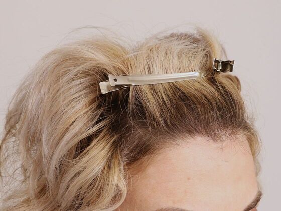 Hair Transplant - Female: Frontal FUT (6) - After female hair transplant