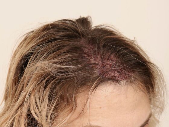 Hair Transplant - Female: Frontal FUT (6) - Post-op female hair transplant