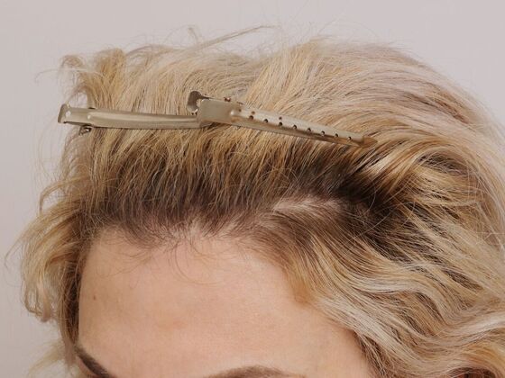 Hair Transplant - Female: Frontal FUT (6) - After female hair transplant