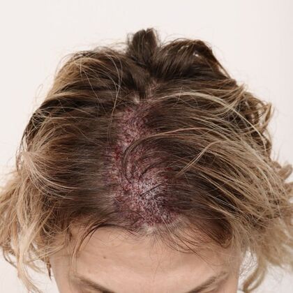 Hair Transplant - Female: Frontal FUT (6) - Post-op female hair transplant