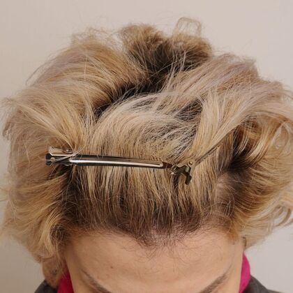Hair Transplant - Female: Frontal FUT (6) - After female hair transplant