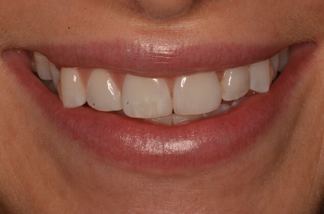 Composite Bonding: Case 10 - Before composite veneers
