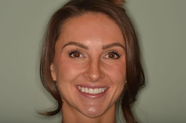 Composite Bonding Case 10 - After