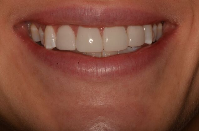 Composite Bonding: Case 10 - After composite veneers