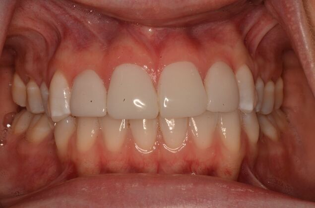 Composite Bonding: Case 10 - After composite veneers