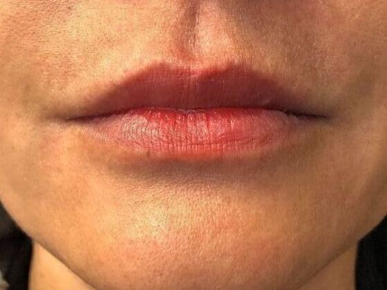 Cosmetic Injectables & Fillers*: Case 46 Lip Filler - Before