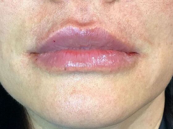 Cosmetic Injectables & Fillers*: Case 46 Lip Filler - After