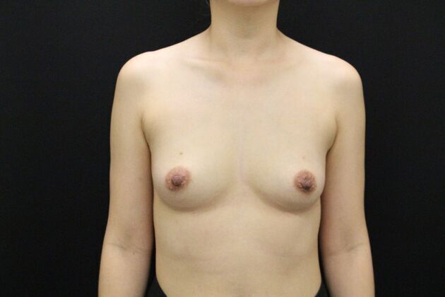 Breast Augmentation Case 2 - Before