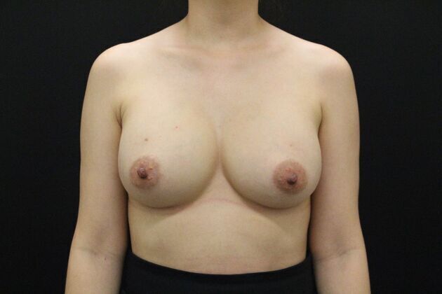 Breast Augmentation Case 2 - After