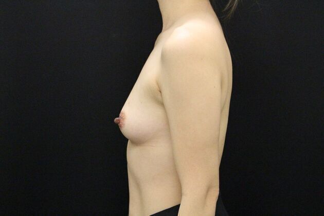 Breast Augmentation: Case 2 - Before