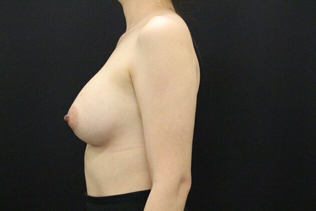 Breast Augmentation: Case 2 - After