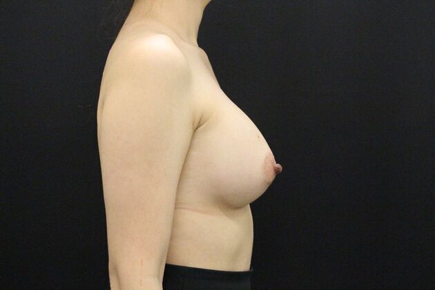 Breast Augmentation: Case 2 - After