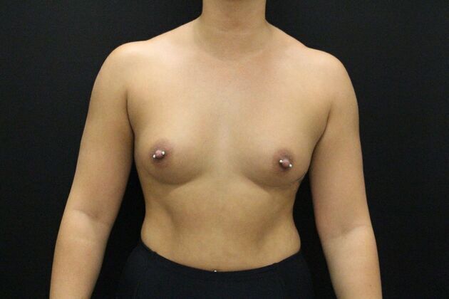 Breast Augmentation Case 3 - Before