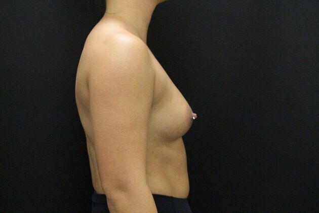 Breast Augmentation: Case 3 - Before
