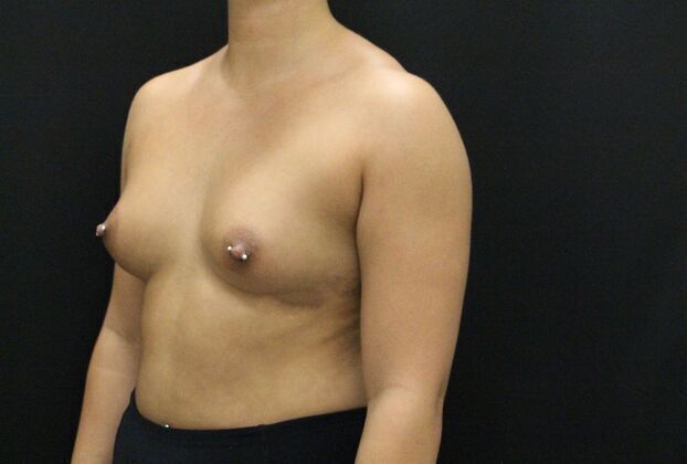 Breast Augmentation: Case 3 - Before