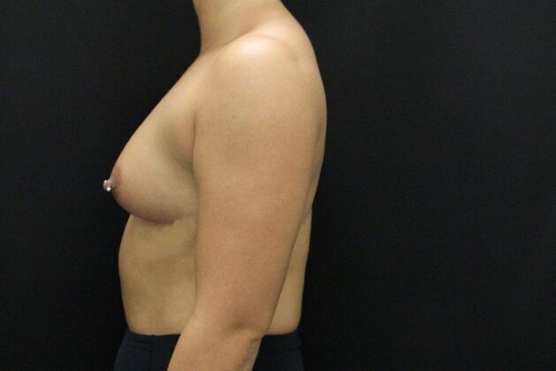 Breast Augmentation: Case 3 - Before