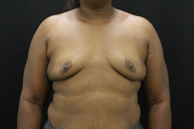 Breast Augmentation Case 4 - Before