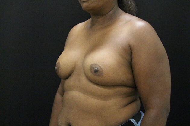 Breast Augmentation: Case 4 - After