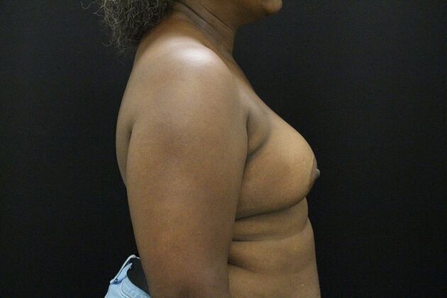 Breast Augmentation: Case 4 - After