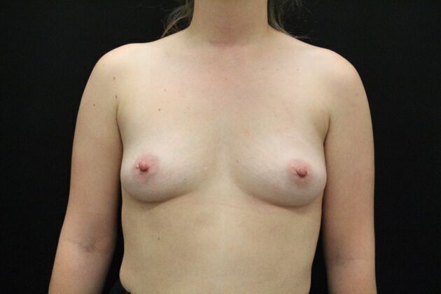 Breast Augmentation Case 5 - Before